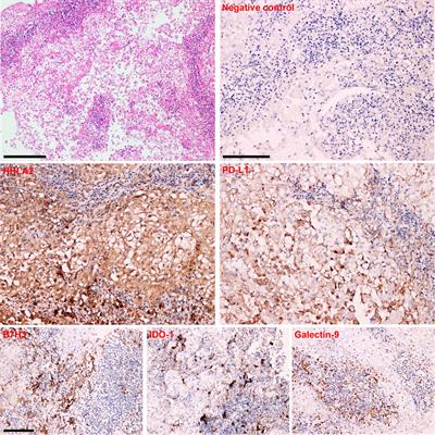 Frontiers Coexpression Of Hhla And Pd L On Tumor Cells